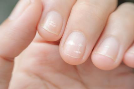 Šta znače promene na noktima i da li su opasne